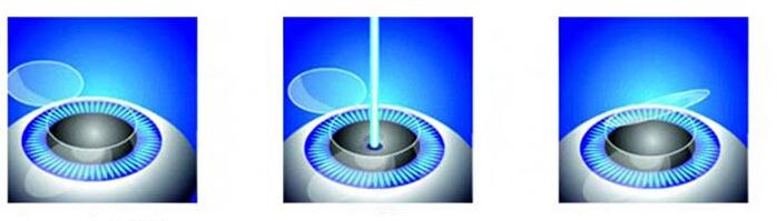Fase della correzione della visione laser