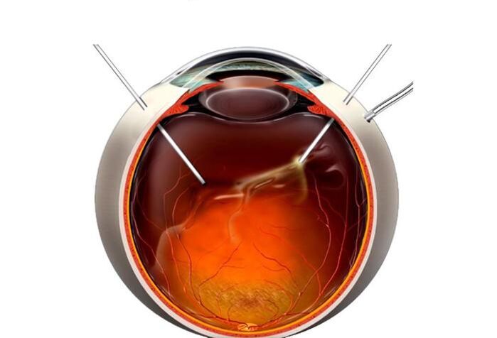 Vitrectomia un'operazione per ripristinare la visione
